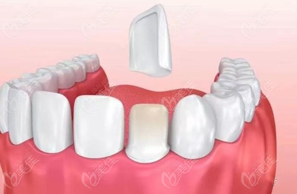 牙齿瓷贴面修复