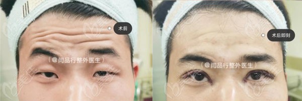 合肥闫品行医生割双眼皮技术好不好，从这些眼综合效果图能明显看出
