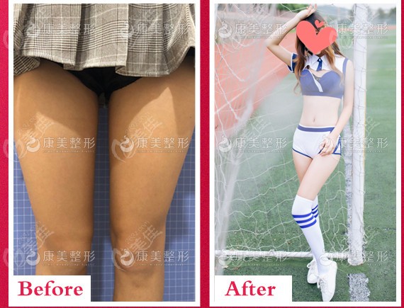 王志軍醫(yī)生多維立體吸脂瘦大腿前后對比
