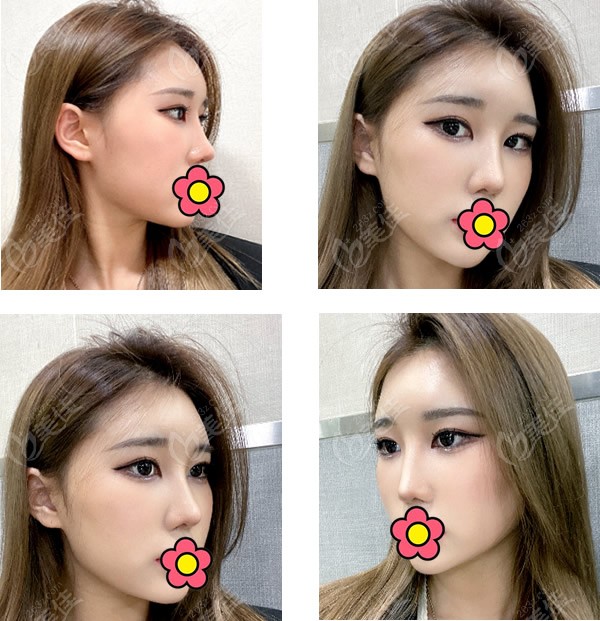 这9张照片，记录了我在韩国做硅胶隆鼻加耳软骨垫鼻尖1~2个月的变化