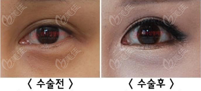 韩国来丽laree整形医院内眼角开大修复效果对比图