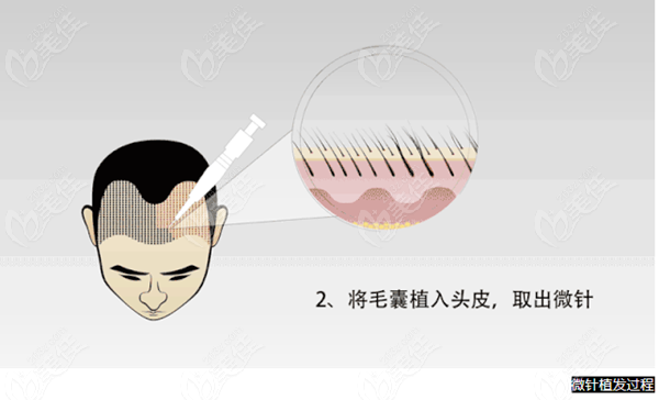 北京大麦微针植发2000个单位多少钱利用pse和ppt技术种发的价格有差别