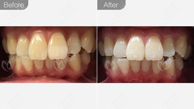 重庆牙卫士口腔洗牙前后对比效果图