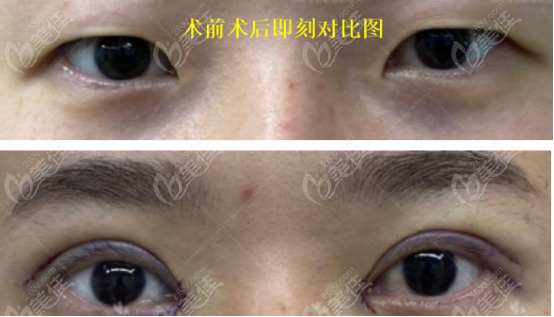 白华宝医生双眼皮多层缝合图