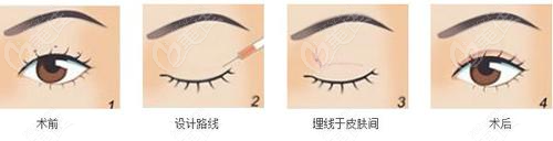 日式无痕双眼皮手术价格一般多少钱？