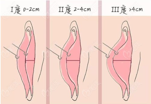 小阴唇肥大的症状