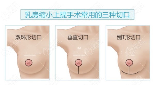 我找杭州栗勇医生做垂直切口棒棒糖缩胸手术的图片：恢复后再也没有胸太大的尴尬了