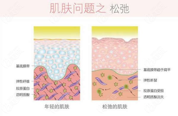 5d胶原光仪器中层提升效果图
