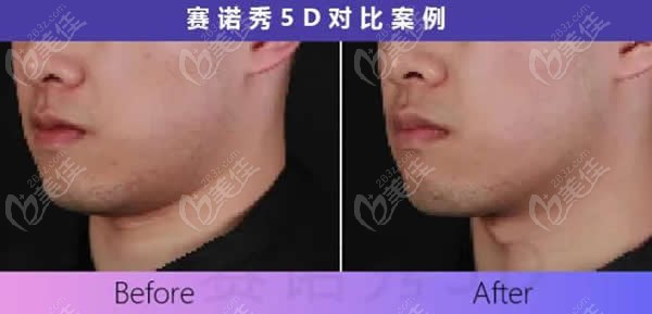 赛诺秀5D胶原光术前和术后即刻对比图片