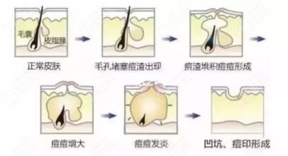 面部痘坑形成的過程示意圖 面部痘坑形成的過程示意圖