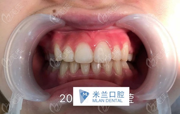 米兰口腔牙齿不齐戴隐形牙套矫正
