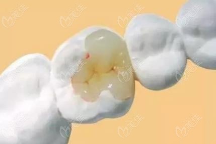 玻璃材质补牙示意图