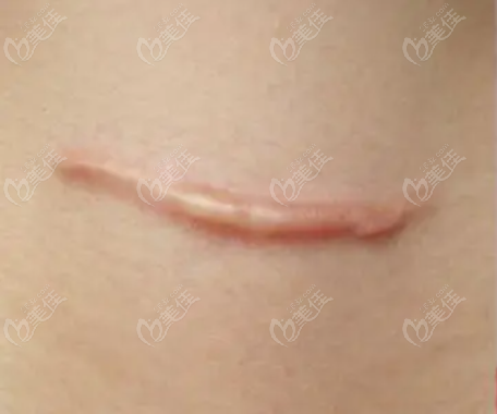 增生性疤痕 增生性疤痕