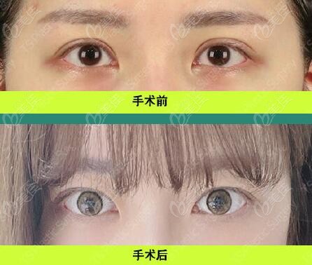 韩国李相均双眼皮修复真人对比照