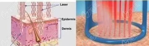 點(diǎn)陣激光治療痤瘡凹坑示意圖 點(diǎn)陣激光治療痤瘡凹坑示意圖