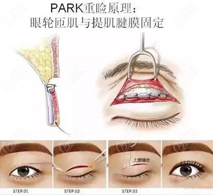 park眼综合手术过程