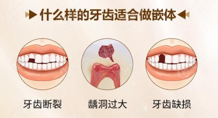 什么样的牙齿适合做嵌体补牙适应症是什么