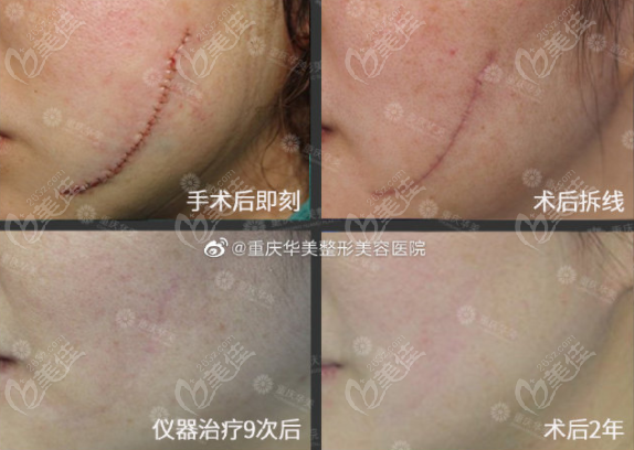 重庆华美手术祛刀疤 激光治疗9次效果图