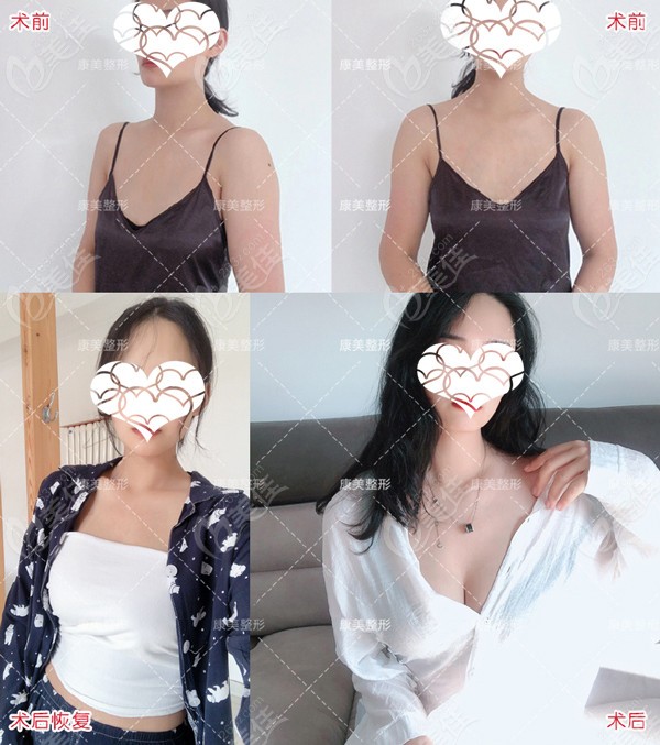 分享在<!--<i data=20240703-sp></i>-->做曼托圆形假体隆胸的经历