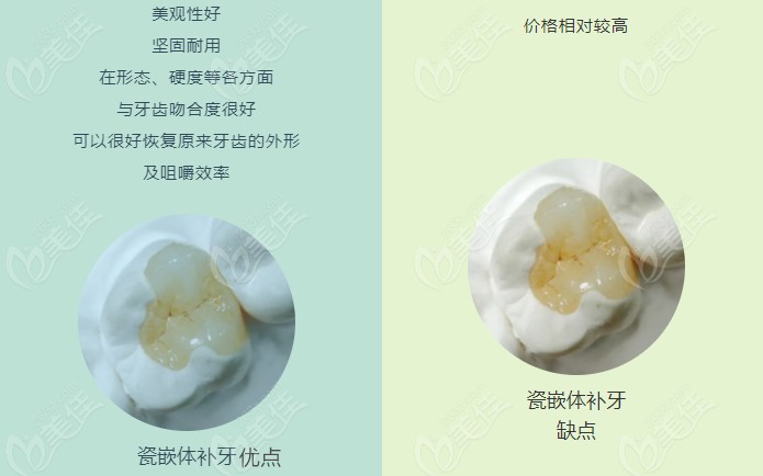 嵌体补牙的优势都有哪些呢