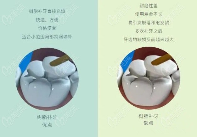普通树脂补牙的优缺点