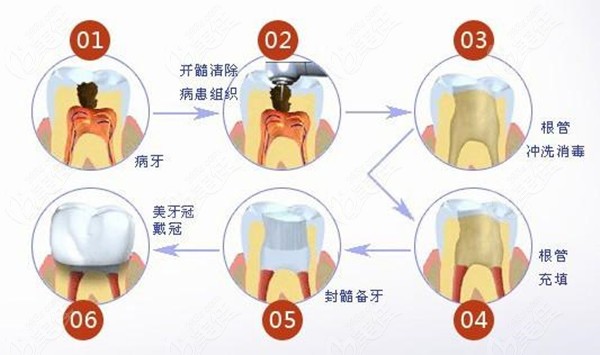 你想知道牙周治疗的流程吗