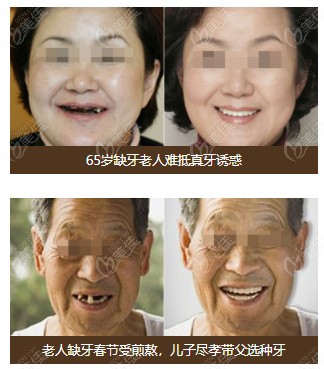 北京康贝佳种牙高龄也能做