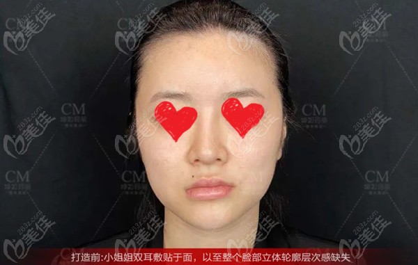 注射精灵耳术前的样子