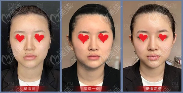 两边各5支莫娜丽莎玻尿酸注射精灵耳的术后效果