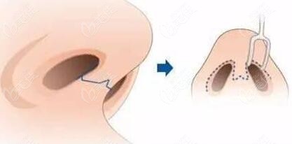 隆鼻手术切口位置