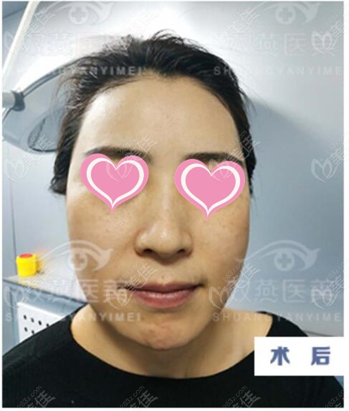 哈尔滨双燕做脸部热玛吉的体验报告:打的全脸900发才花了1万多