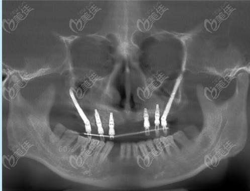 暨大穗华半口穿颧骨种植牙经历分享，上颌牙槽骨严重吸收不植骨也可以种牙