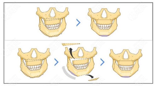 偏颌做双颌手术过程