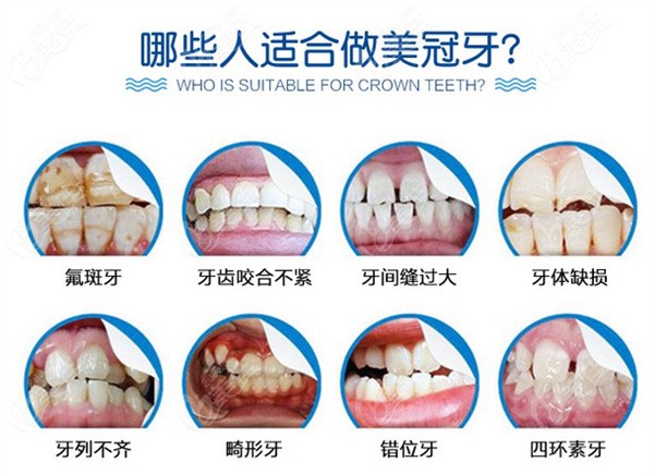 威兰德全瓷牙适应人群