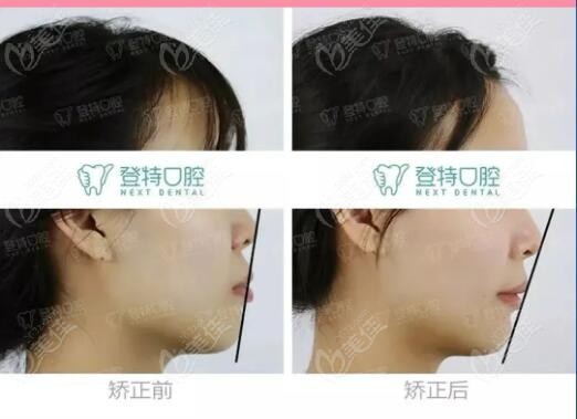 深圳登特口腔做牙齿矫正<span style=