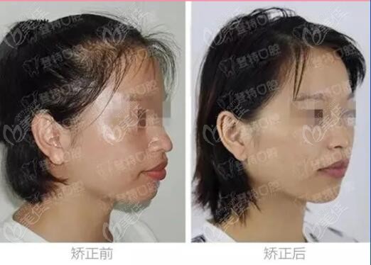 深圳登特口腔正畸真人<span style=
