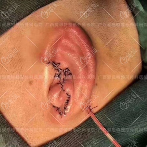 耳廓植入支架后的效果
