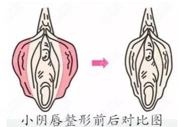 小阴唇肥大缩小手术前后对比示意图
