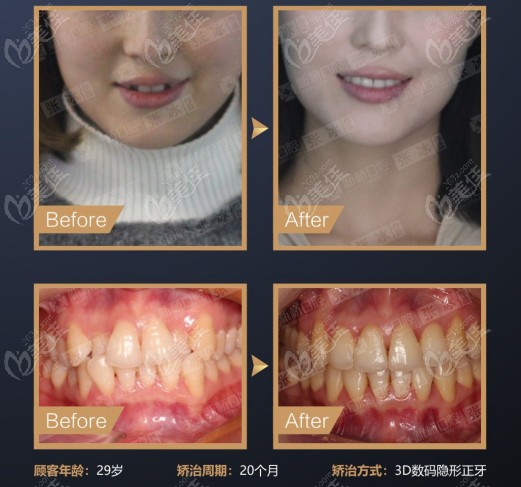 成都新橋口腔牙齒擁擠及反頜顧客矯正效果