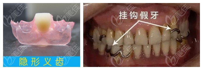 挂钩假牙和无挂钩假牙图示