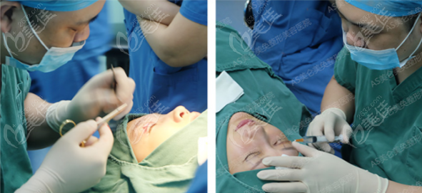 董院长用的是美国force fxtm-8c高频电刀,10秒就能快速雕刻出双眼皮线