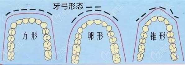 牙弓的形态示意图