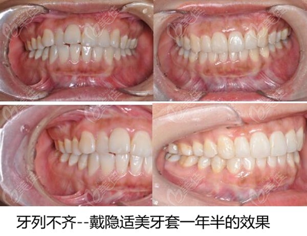 北京佳美口腔周蕾医生做的牙列不齐病例