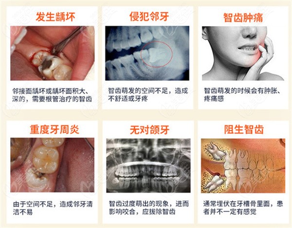 需要拔智齿的类型.jpg