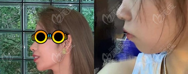 凸嘴下巴后缩正畸的效果图