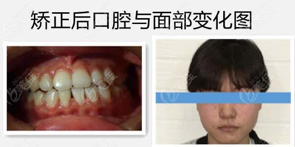 欧联医生矫正后效果