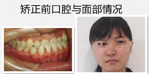 欧联医生矫正前图片