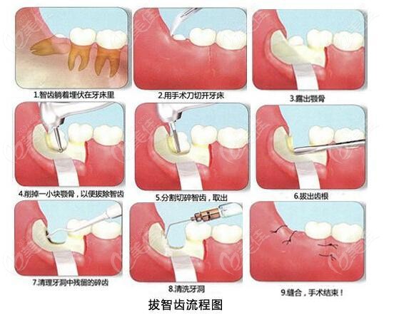 致美口腔医院拔智齿牙的流程图