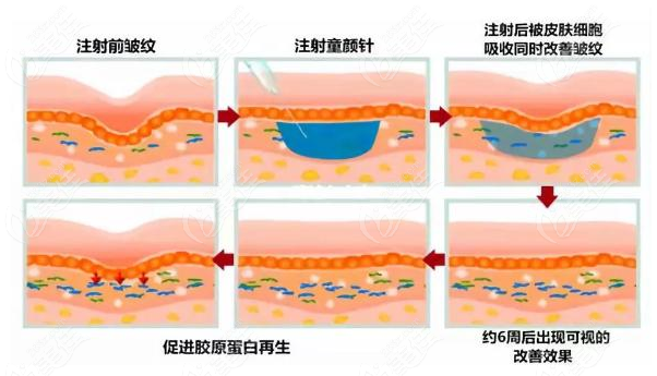 童颜针填充泪沟的改善效果