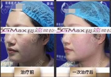 5gmax极速提拉脸部即可效果图